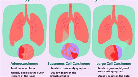 Lung Cancer Hyponatremia