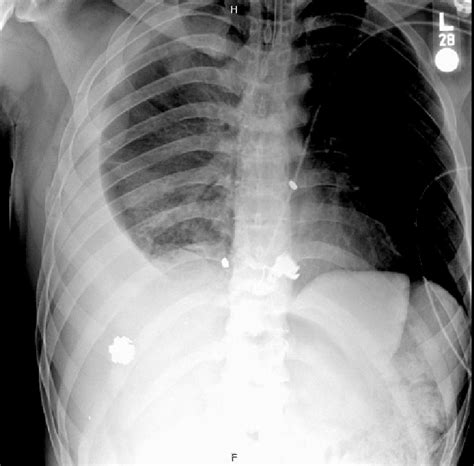 Chest X-ray taken in the trauma bay showing bullet shrapnel overlying... | Download Scientific ...