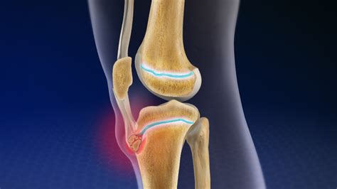 Quick Facts on Osgood-Schlatter Disease | Kinetic Labs