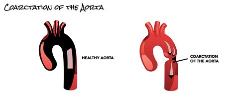 Coarctation of the Aorta | SCAI - Seconds Count