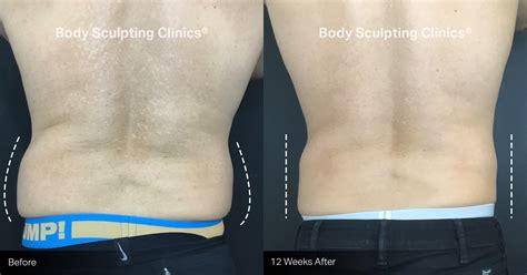 Before and After | Body Sculpting Clinics