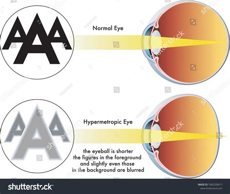 Medical Illustration Symptoms Hypermetropia Stock Vector (Royalty Free) 1982328917 | Shutterstock