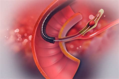 Bile Duct Stones Singapore - Liver Stones | Alpha Digestive