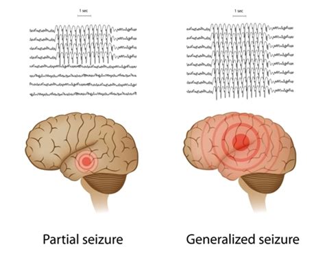 Absence Seizures - Net Health Book