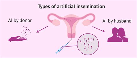 Artificial Insemination Cost | Best Low Cost IVF 2021