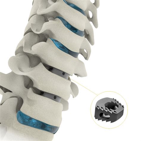 Best Spine Implants Manufacturer | Spine Implants Manufacturer