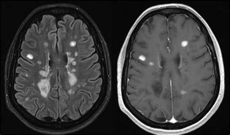 Multiple Sclerosis Mri Flair