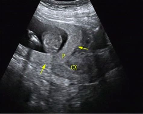 Antepartum Hemorrhage | Concise Medical Knowledge