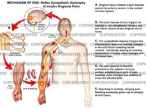 MECHANISM OF RSD: Reflex Sympathetic Dystrophy (Complex Regional Pain ...