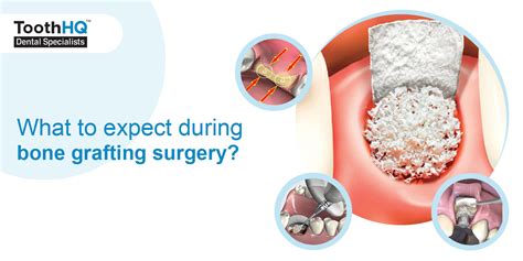 What to expect during Bone Grafting surgery? - ToothHQ Dental Specialists