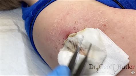 Removal of a Pyogenic Granuloma - YouTube