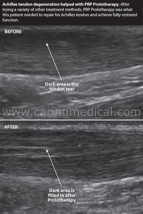 Achilles Tendon Repair Protocol Jospt : Achilles Tendon Loading During Weight Bearing Exercises ...