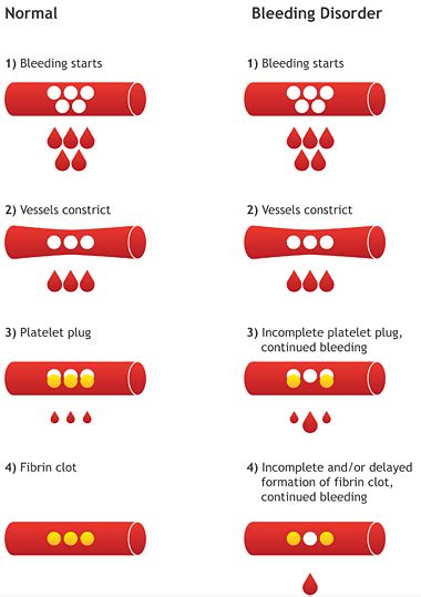 Managing Hemophilia