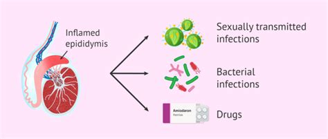 Epididymitis and its causes
