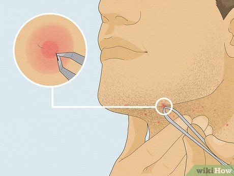 How to Get Rid of Razor Bumps on Your Neck: 13 Easy Remedies