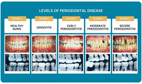 4 Periodontal Disease Stages: From Gingivitis to Tooth Loss