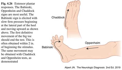 What Is The Clinical Significance Of Babinski Sign Flash Sales | aria-database.com