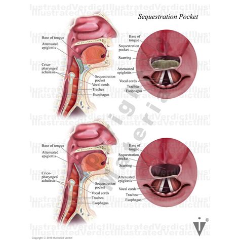 CASE AT A GLANCE: Partial Epiglottis Removal After Tongue Cancer Treatment — Illustrated Verdict