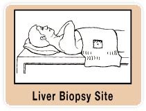 Liver Biopsy - My Life With Cirrhosis