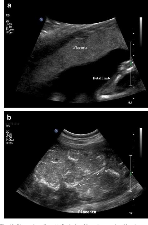 Fundal Placenta Ultrasound