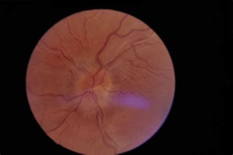 Papillitis - Retina Image Bank