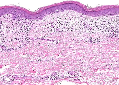 Mycosis Fungoides Histology