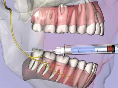 buccal nerve block.mp4 - YouTube