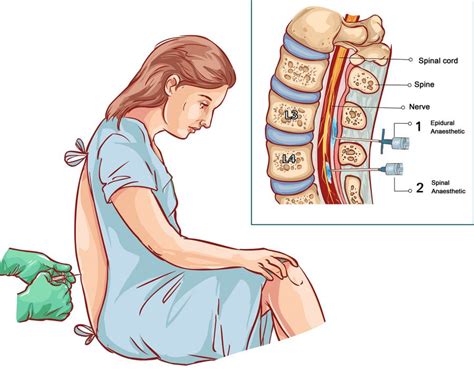 Spinal Injections for Pain Management – SAPNA Pain Management Blog