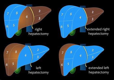 The Radiology Assistant : Liver - Segmental Anatomy