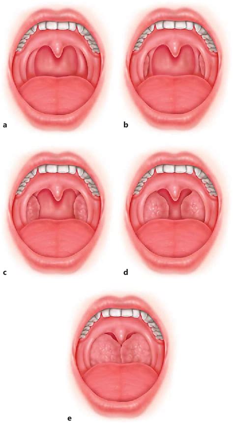 Updated Friedman Staging System for Obstructive Sleep Apnea. | Semantic ...