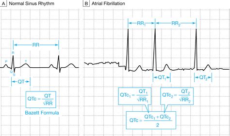 What Clinicians Should Know About the QT Interval | JAMA | The JAMA Network