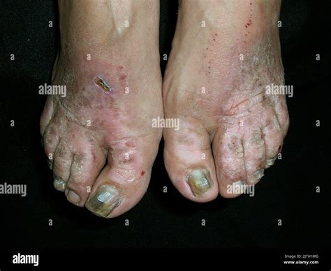 Atypical palmar plantar psoriasis Stock Photo - Alamy