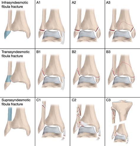 The AO/OTA classification of ankle fractures. Illustration by Pontus... | Download Scientific ...