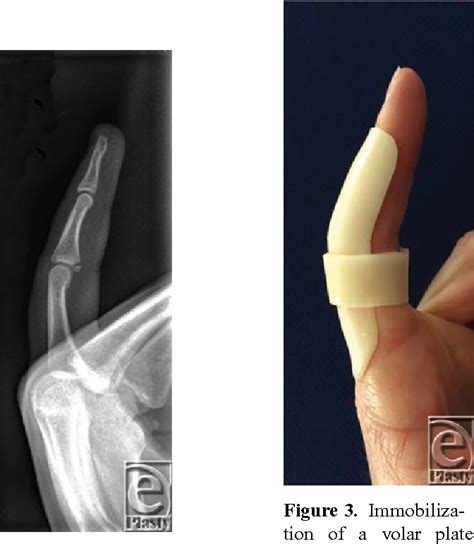 Table 1 from Volar Plate Avulsion Injury | Semantic Scholar