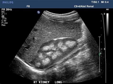 WK 7 RENAL PATHOLOGY This ultrasound image shows increased echogenicity of the renal medulla ...