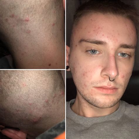 Constant scalp spots and red spots on face. Any advice or help greatly appreciated! : r/acne