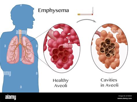 Illustration depicting emphysema, a condition characterized by damage to the alveoli. Normal ...