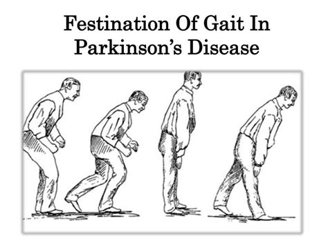 Festination Of Gait In Parkinson’s Disease