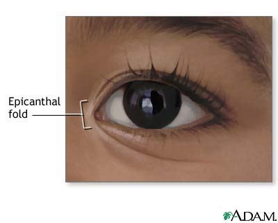 Epicanthal fold: MedlinePlus Medical Encyclopedia Image