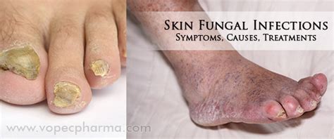 Skin Fungal Infections: Symptoms, Causes, Treatments