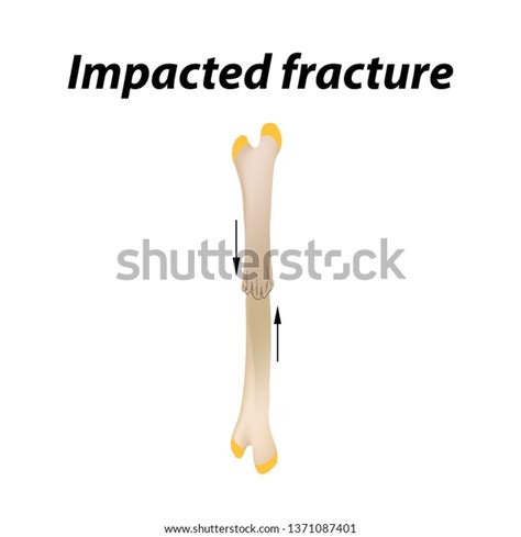 Impacted Fracture Bone Infographics Illustration On Stock Illustration ...