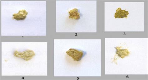 How reliably can paediatric professionals identify pale stool from cholestatic newborns ...