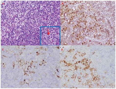 Pituitary stalk lesion in a 13-year-old female. - Abstract - Europe PMC