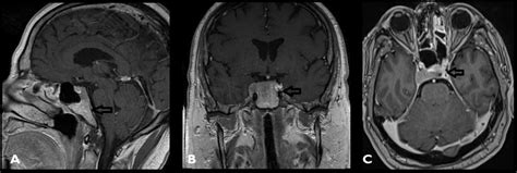 Cureus | Metastatic Disease to Clivus: Biopsy or Not?