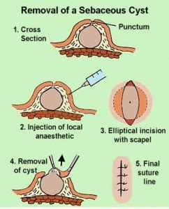 Sebaceous Cyst (Epidermal Cyst) - Pictures, Causes, Treatment and Removal