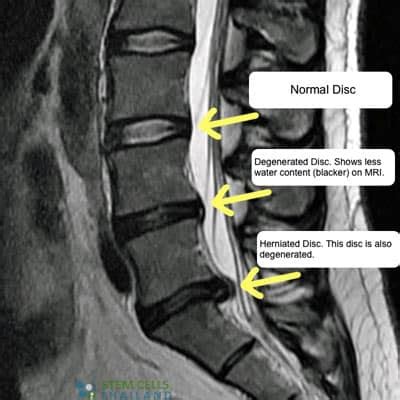 Stem Cell Therapy DDD Degenerative Disc Disease