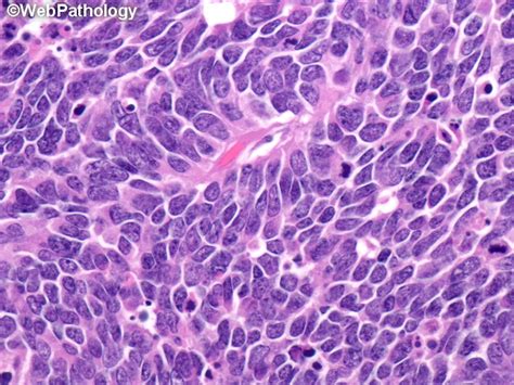 Webpathology.com: A Collection of Surgical Pathology Images