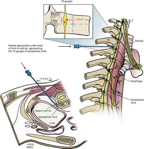 Lumbar Sympathetic Block | Aptiva Health