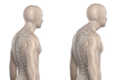 Kyphosis Causes Symptoms Exercises Surgery Treatment - vrogue.co