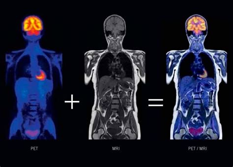 47 best Nuclear Medicine images on Pinterest | Nuclear medicine, Pet ct ...